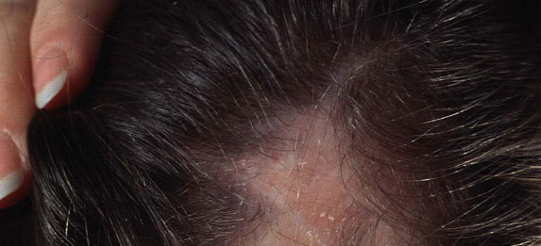 Tips for Coping with Telogen Effluvium - Hair Growth Cycle, Causes