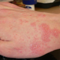 Skin Allergies and Rashes - Types, Causes and Treatments