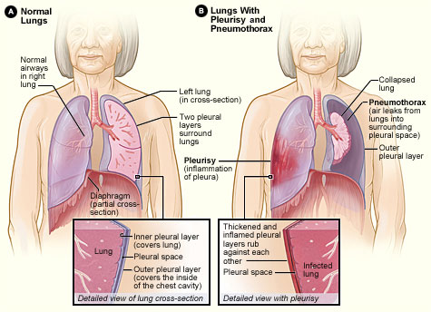 pleurisy remedies natural