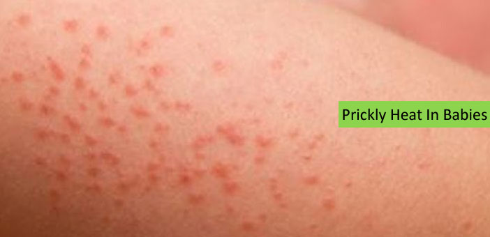 Home Remedies For Prickly Heat In Babies And Kids